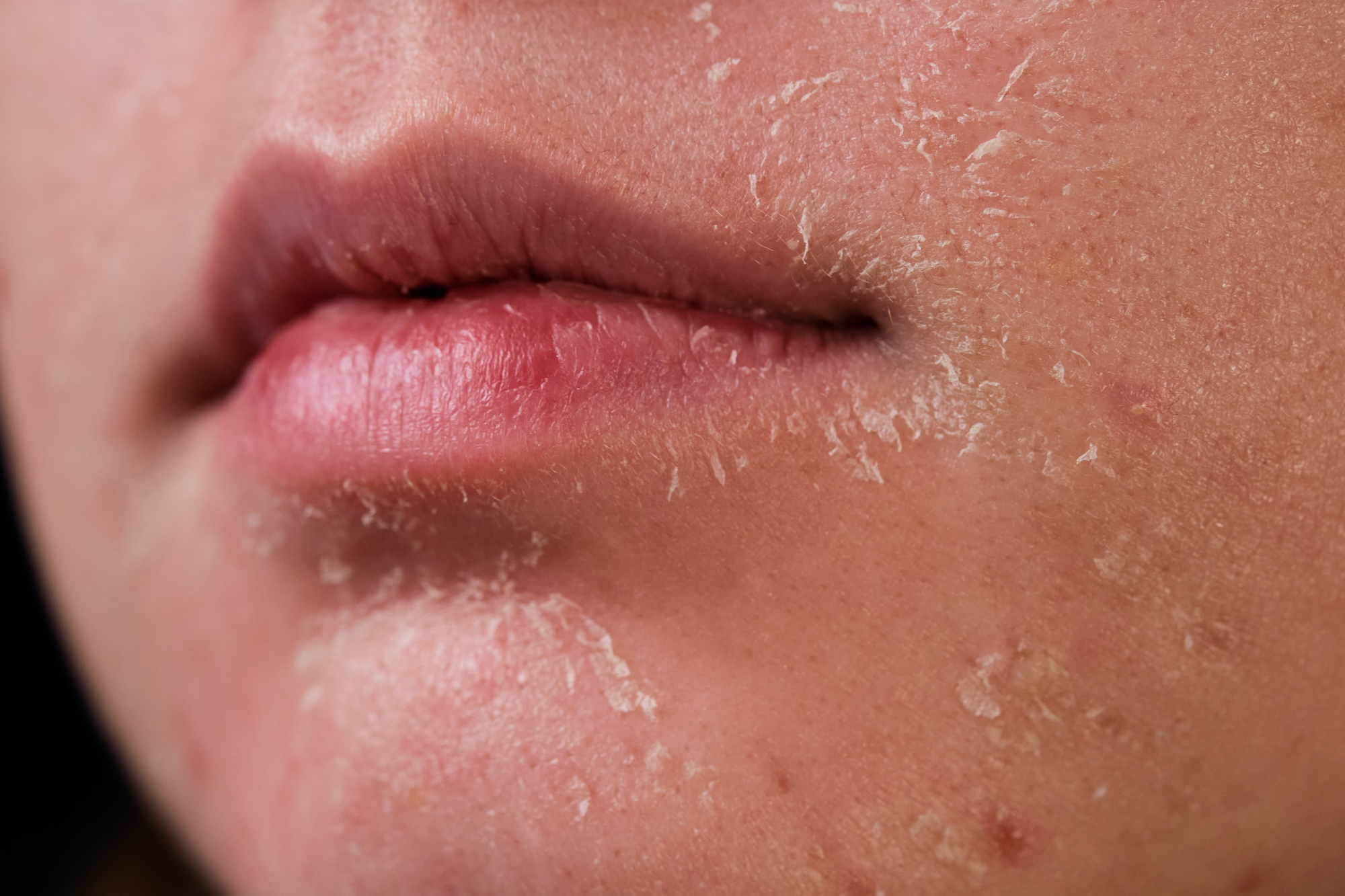 Dry-Skin-Stock-Photo