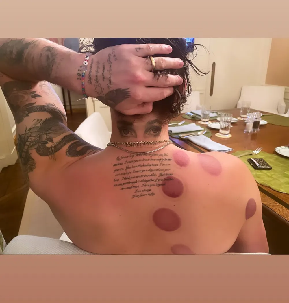 Everything We Know About Brooklyn Beckham&rsquo;s Body Bruising Treatment