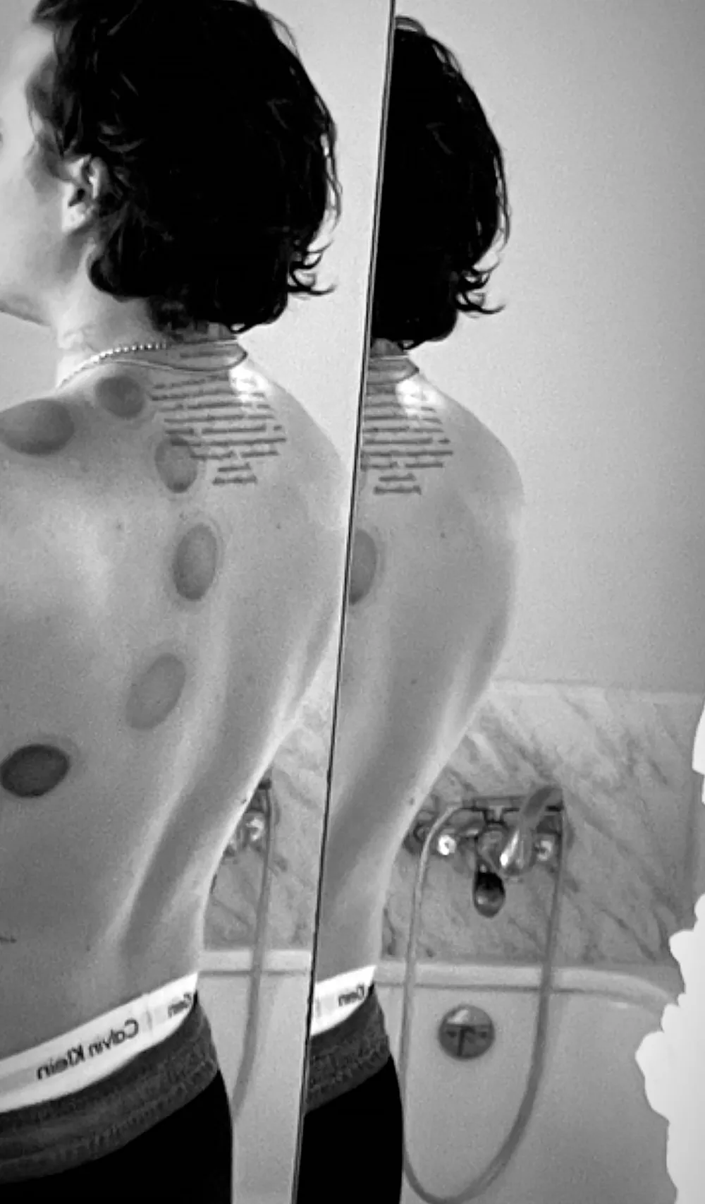 Everything We Know About Brooklyn Beckham&rsquo;s Body Bruising Treatment