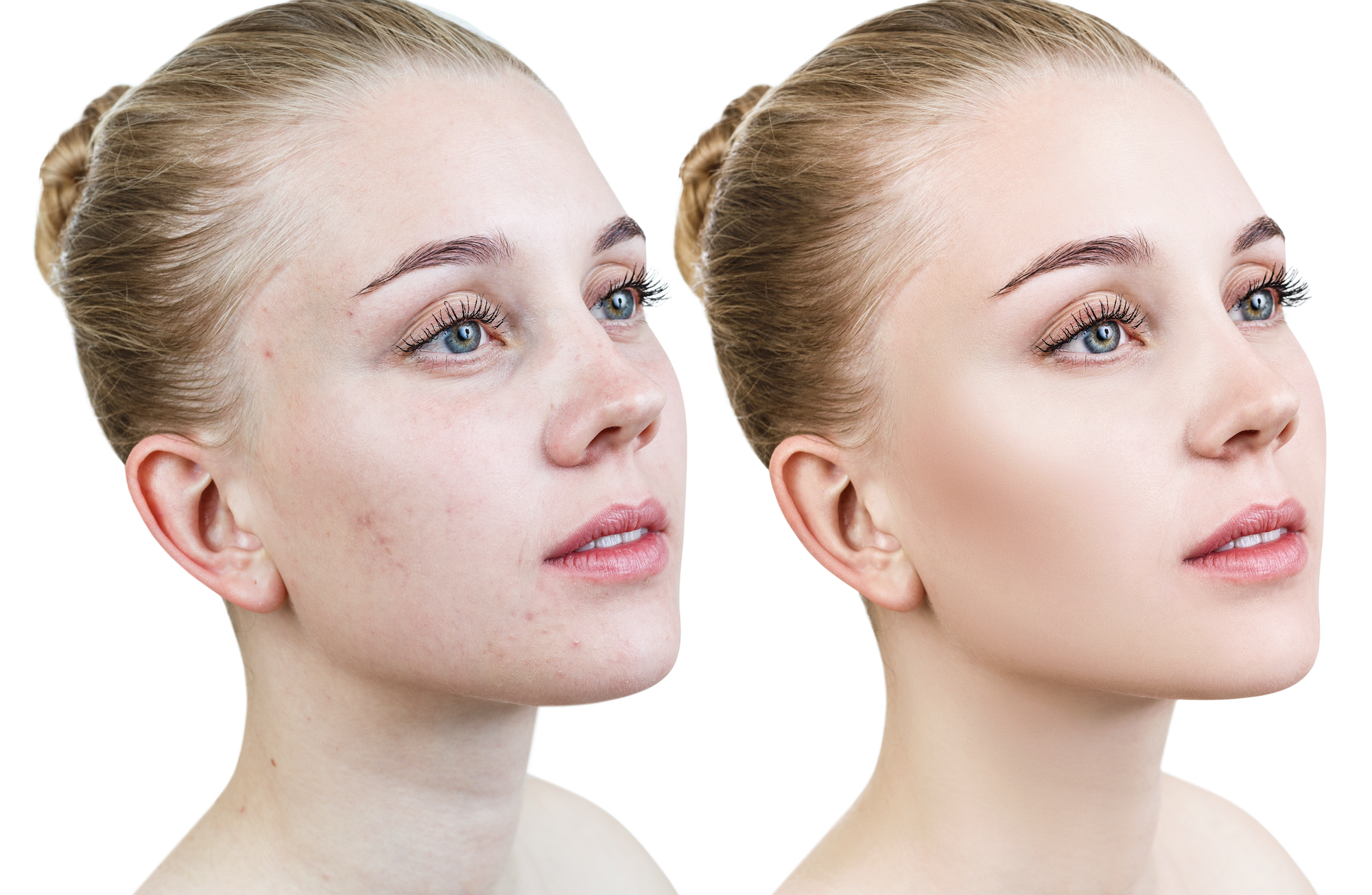 Skincare-Before-After-Stock-Photo