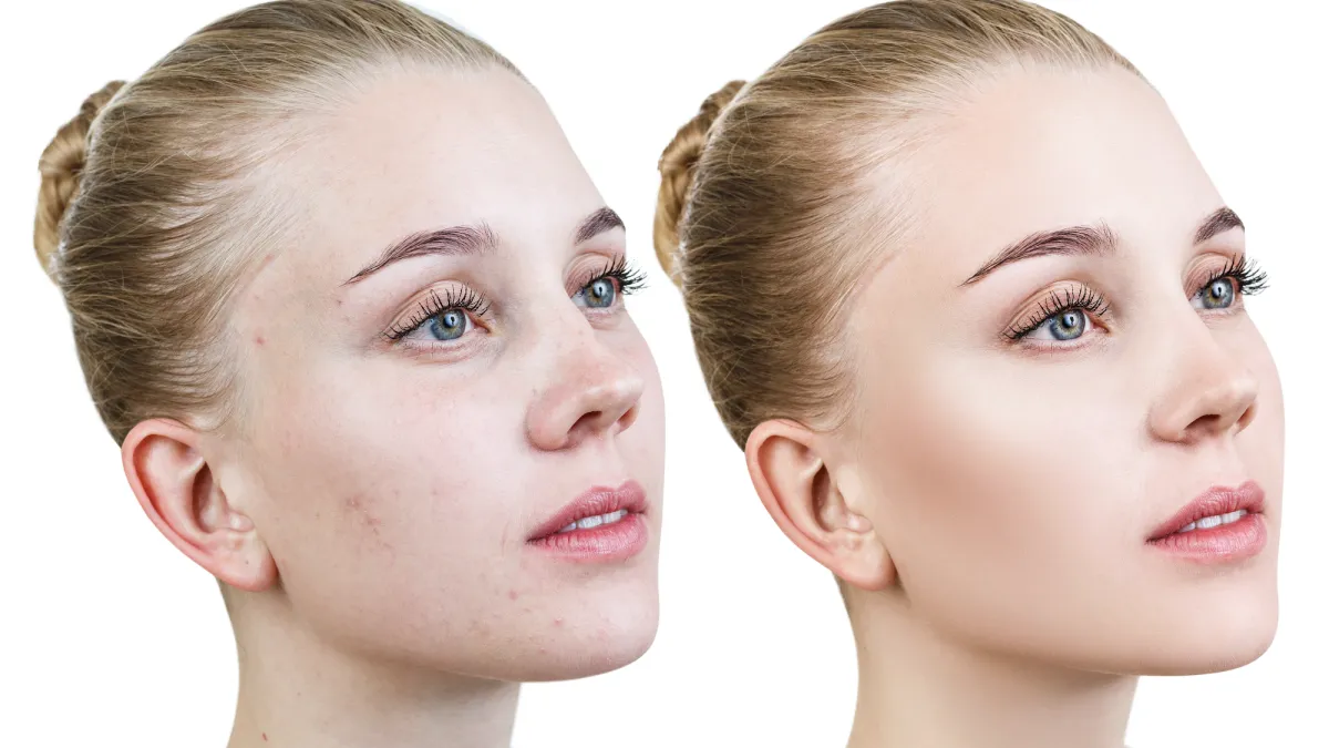Skincare-Before-After-Stock-Photo