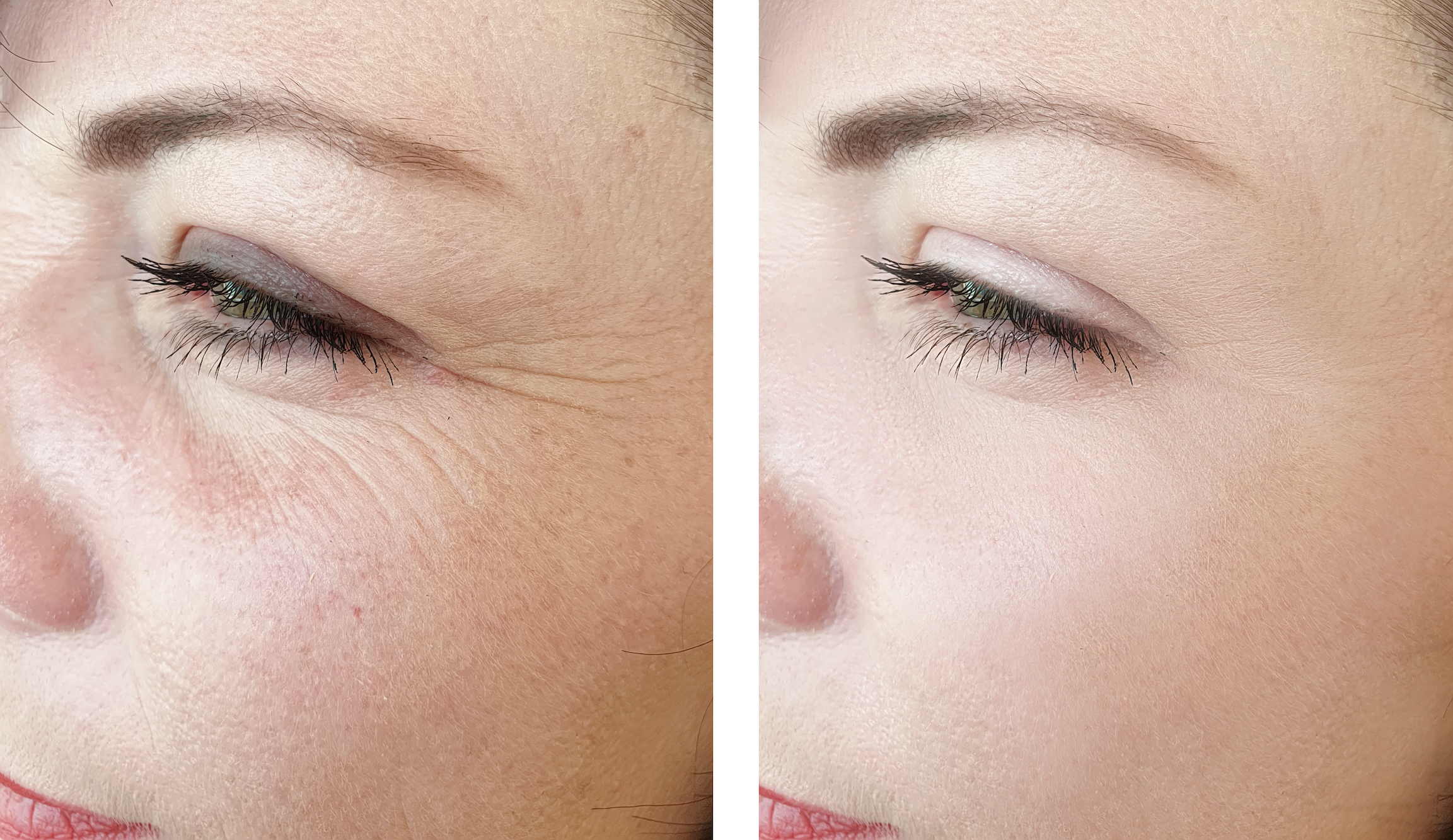 Woman-Before-After-Wrinkles