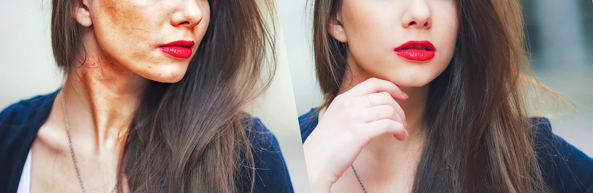 hyperpigmentation-before-after