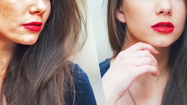 hyperpigmentation-before-after