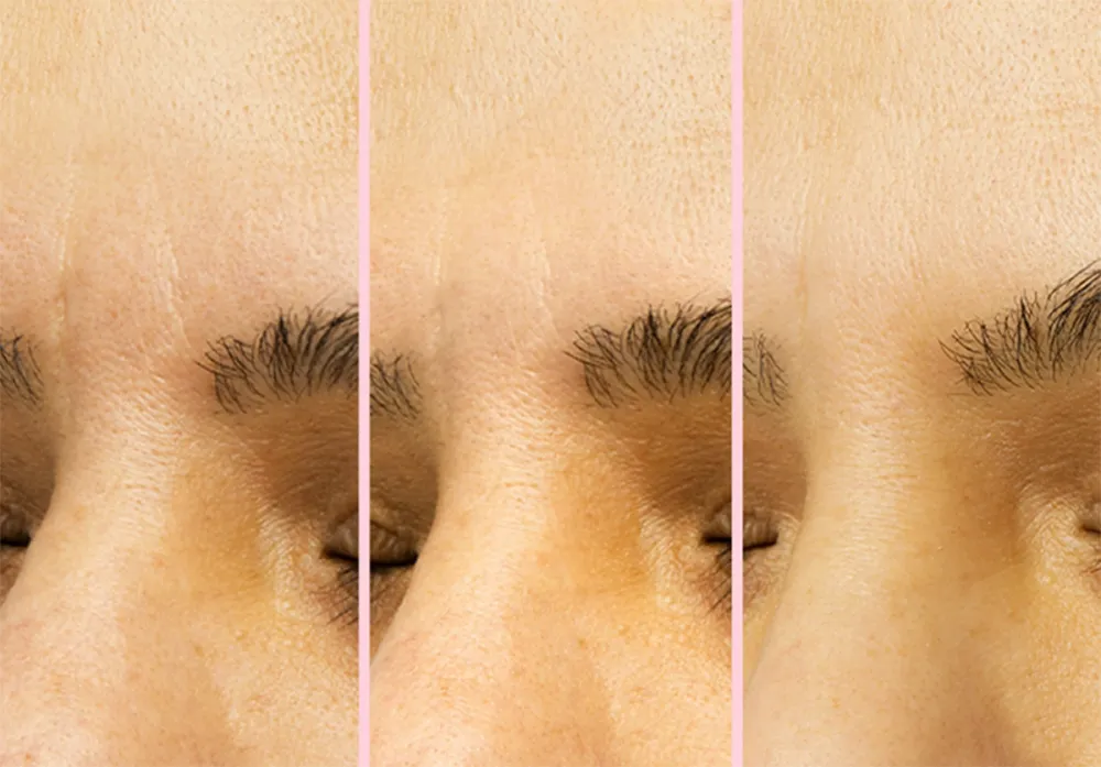 peace-out-microneedling-patches-wrinkle-before-after-2