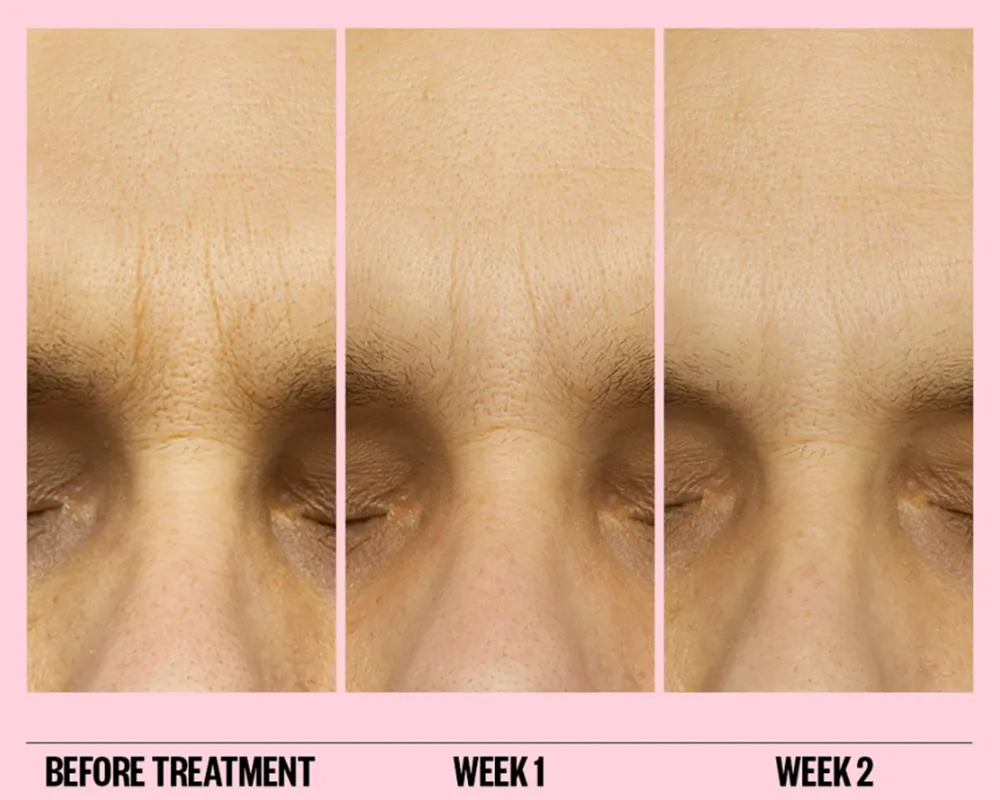 peace-out-microneedling-patches-wrinkle-before-after