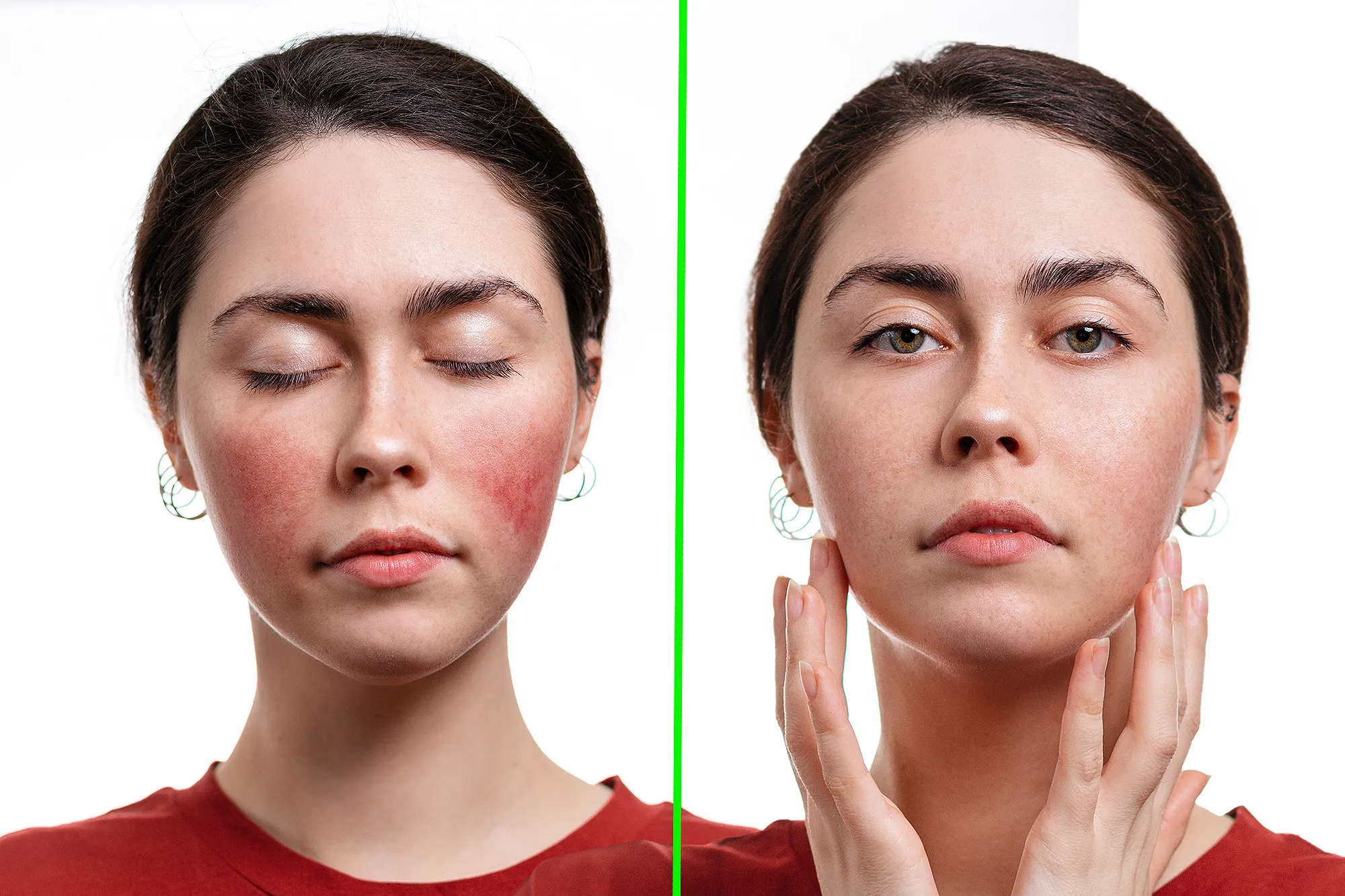 red-rosacea-before-after-skincare