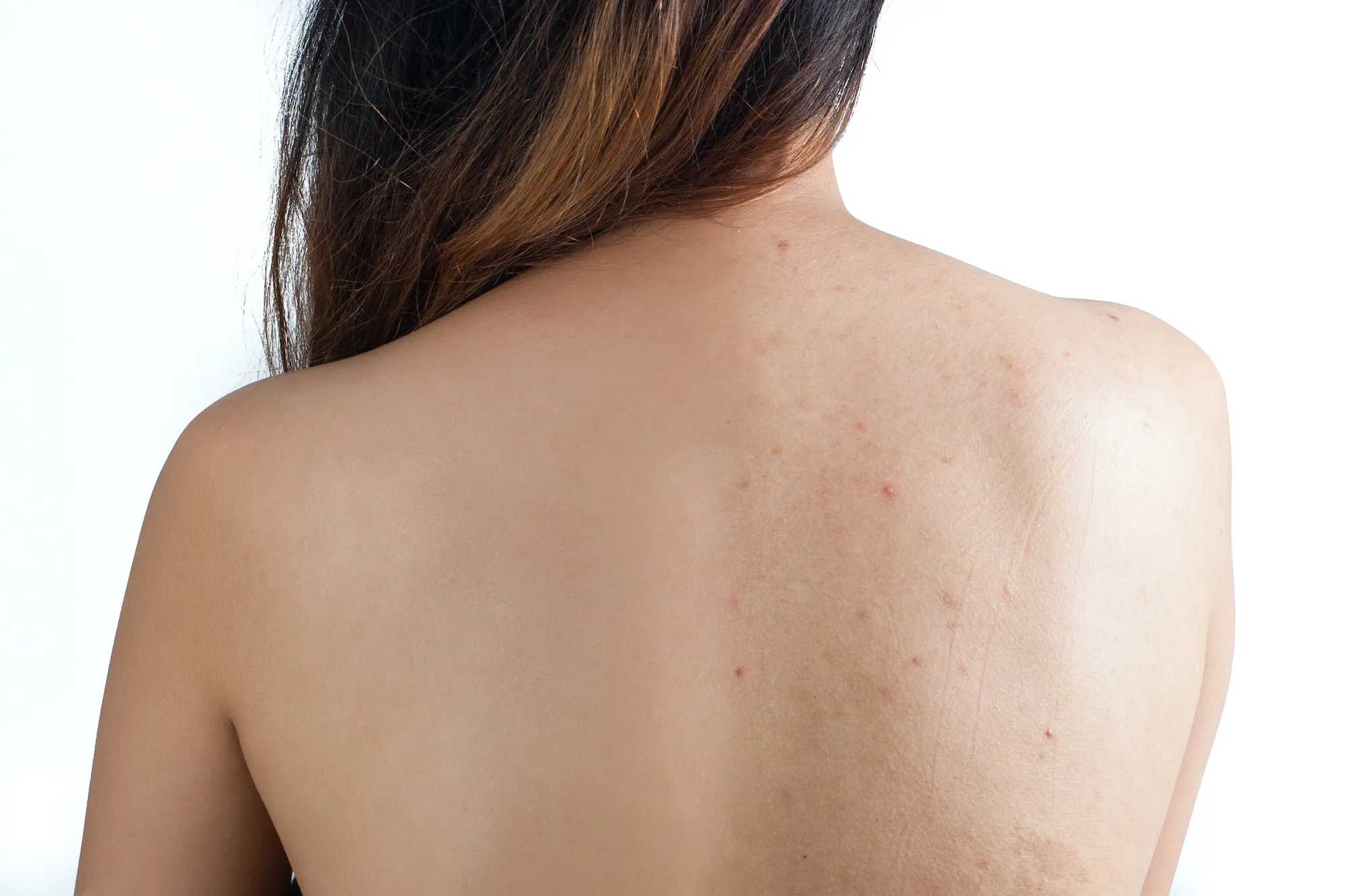 Before-After-Body-Acne-Stock-Photo