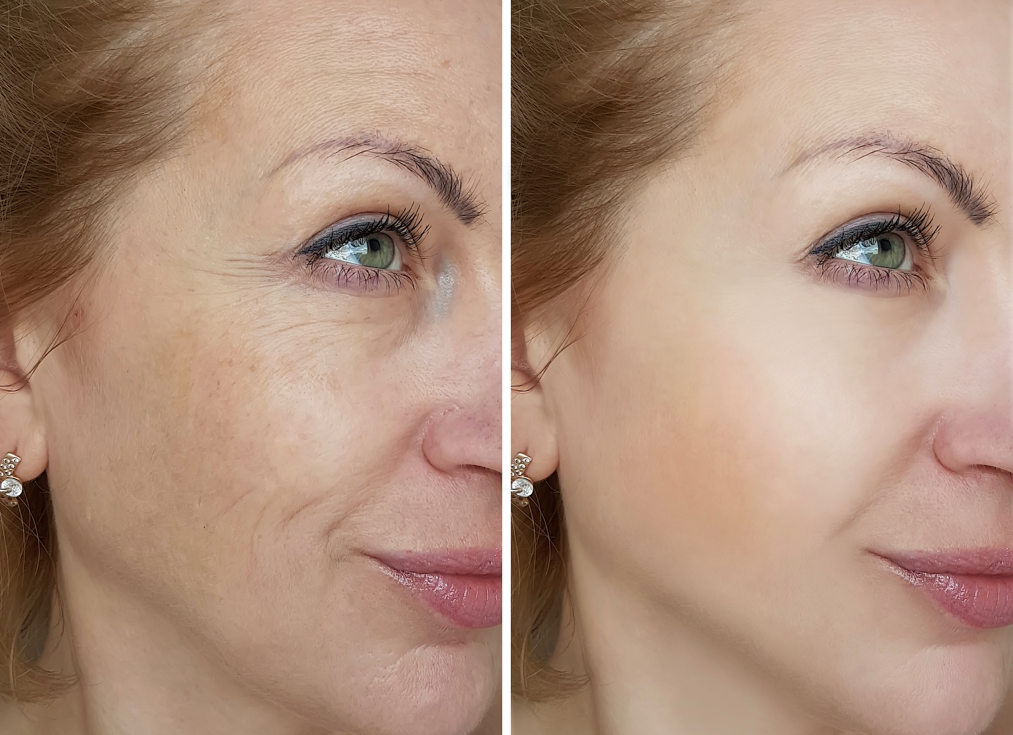 Before-After-Brighter-Skin-Stock-Photo