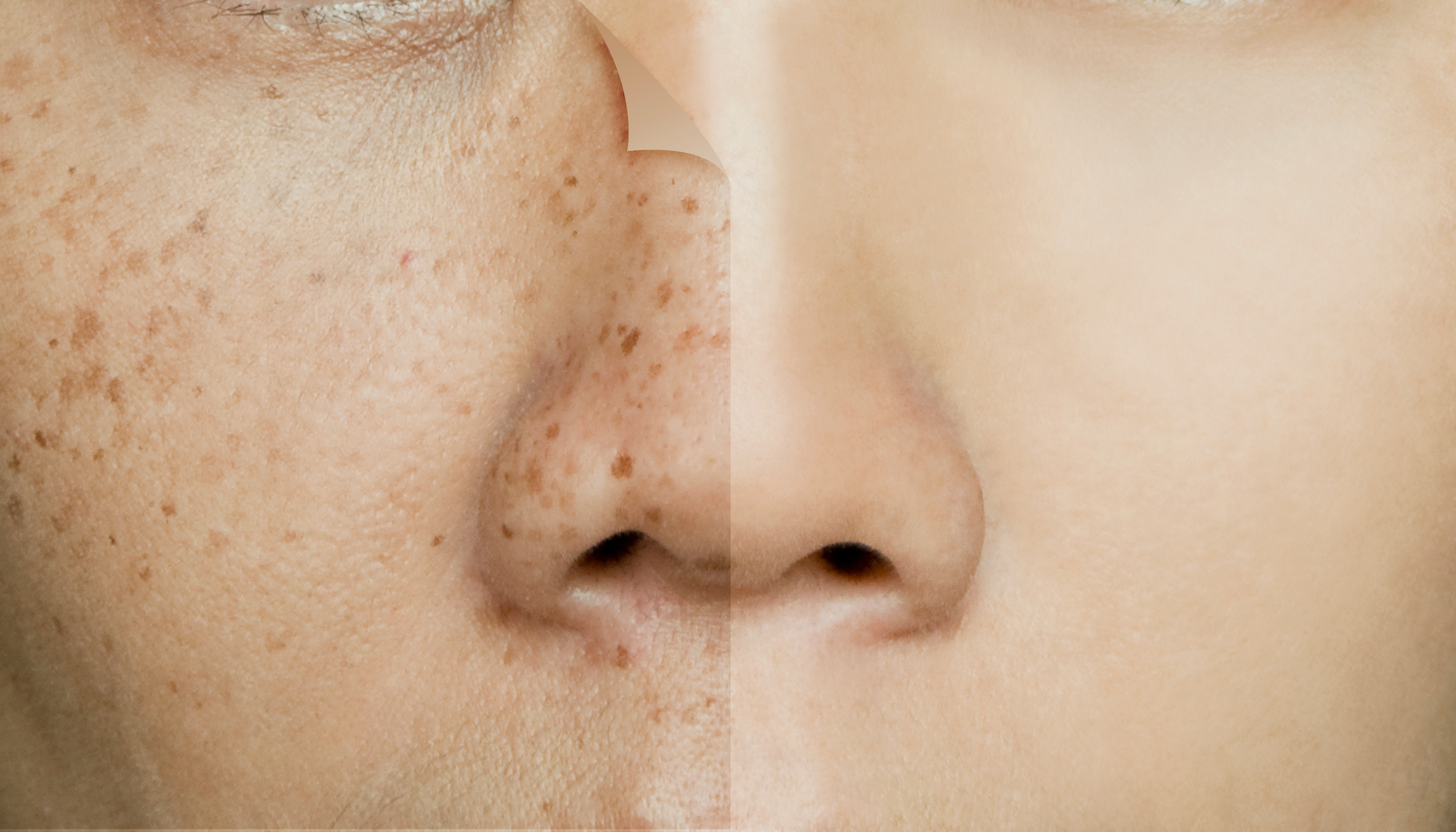 Before-After-Dark-Spots-Stock-Photo