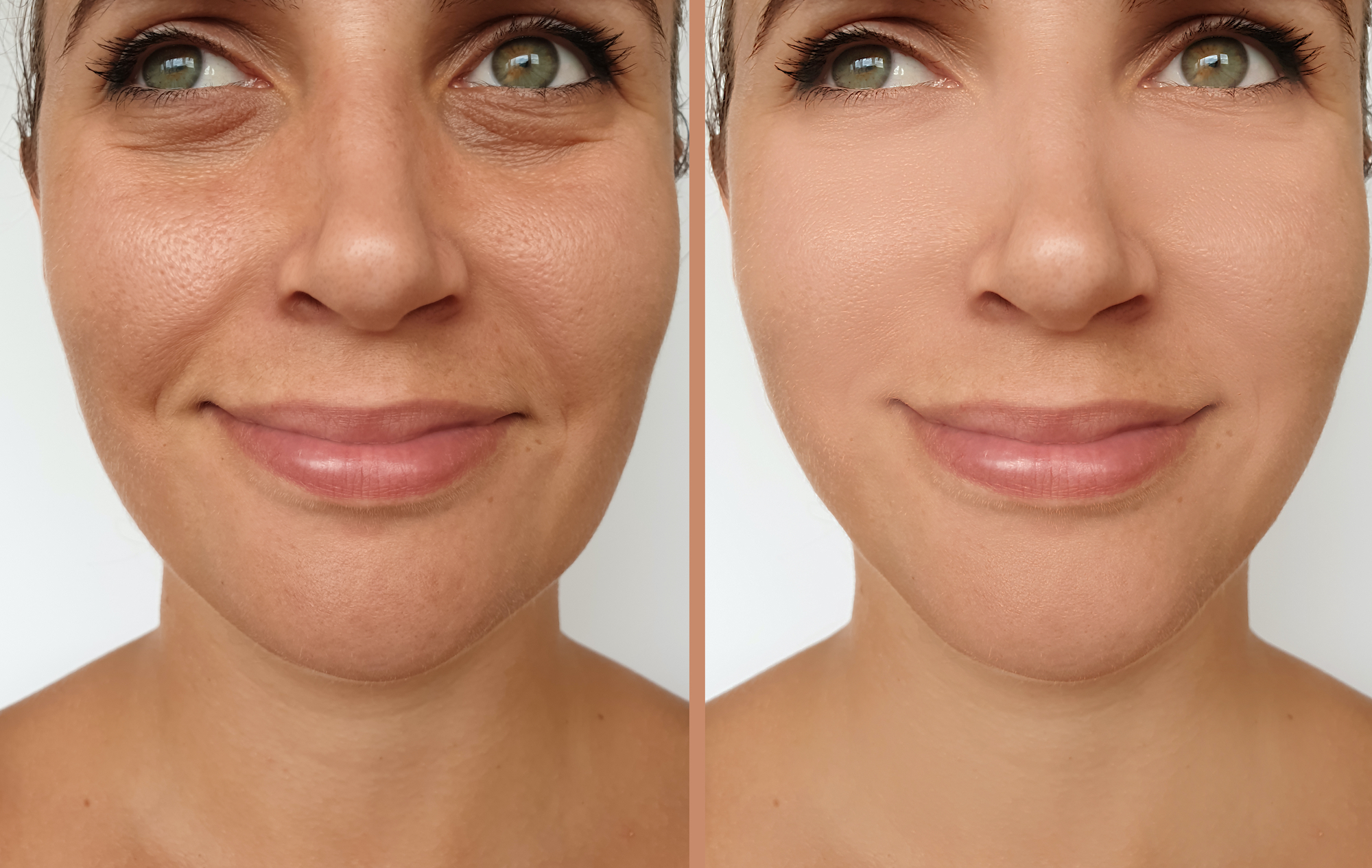Before-After-Wrinkle-Treatment-Stock-Photo