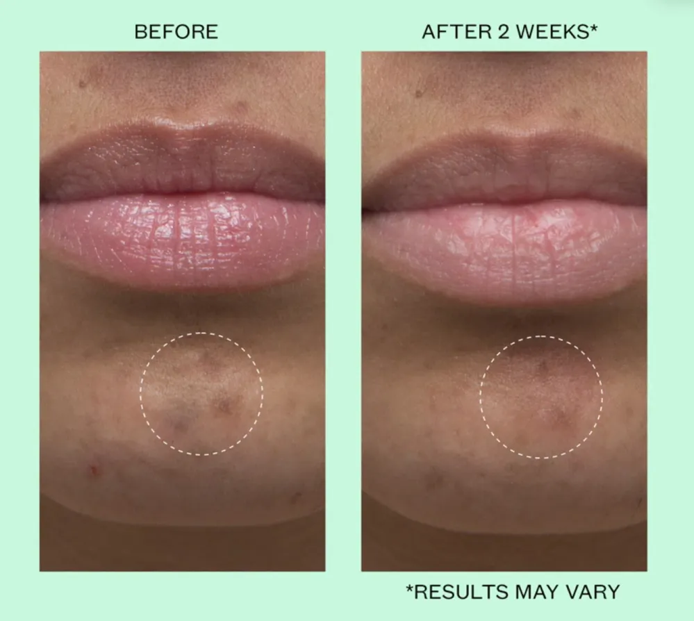 Peace Out Dark Spots Dissolving Microneedling Brightening Dots