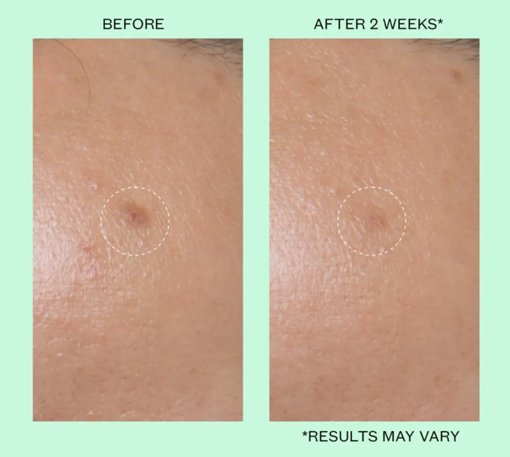 Peace Out Dark Spots Dissolving Microneedling Brightening Dots