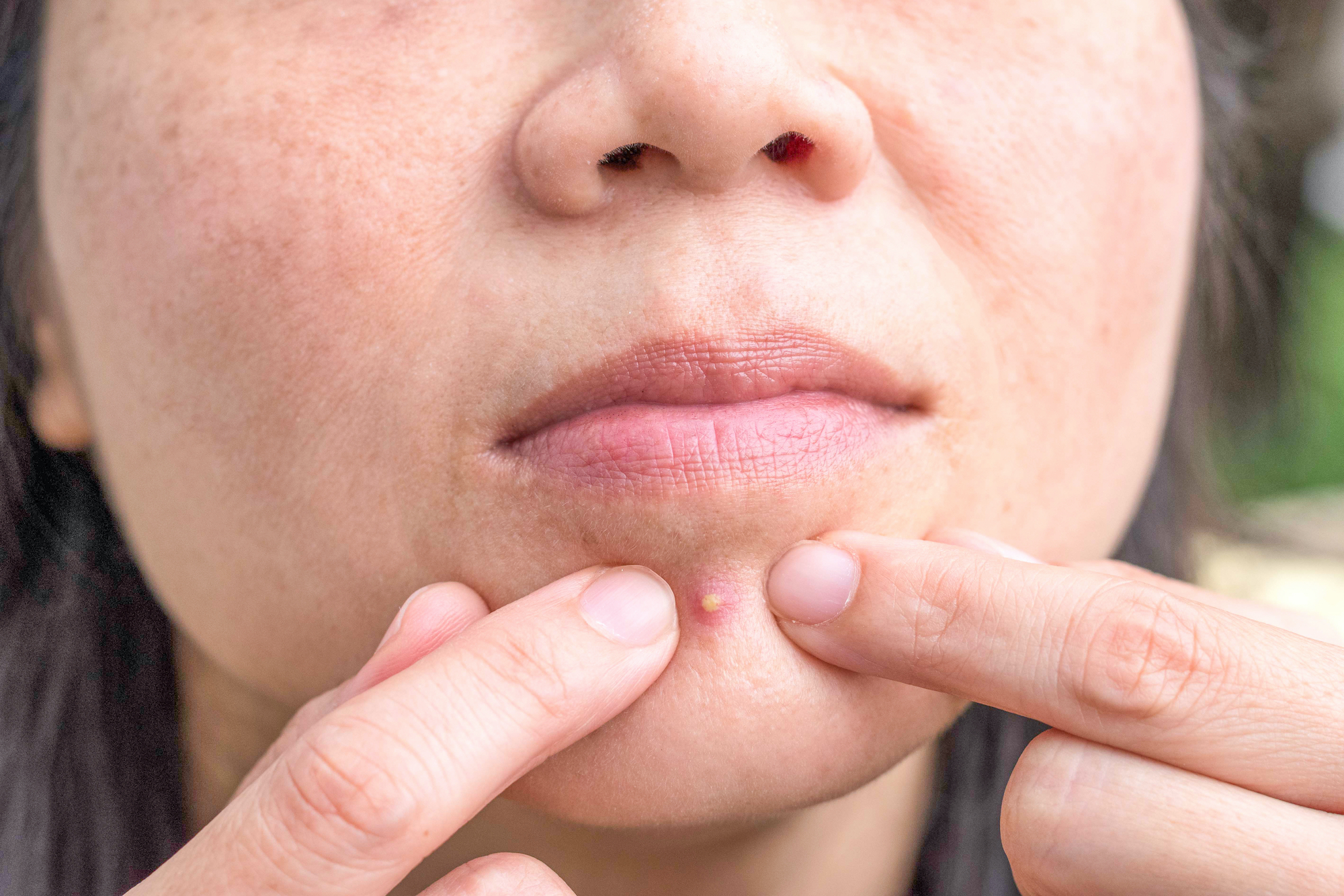Pimple-Popping-Stock-Photo