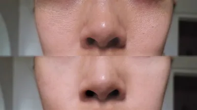 before-after-pores