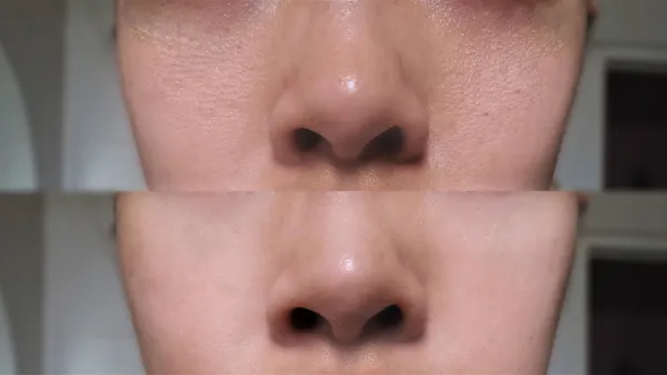 before-after-pores