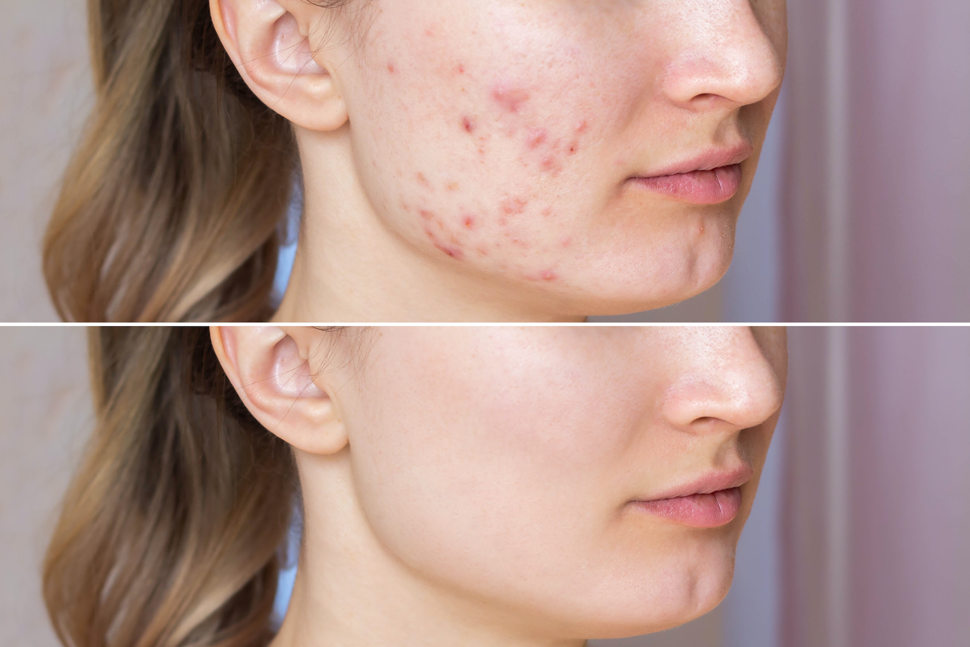 Before-After-Acne-Mask-Stock-Photo