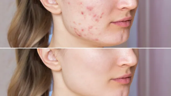 Before-After-Acne-Mask-Stock-Photo