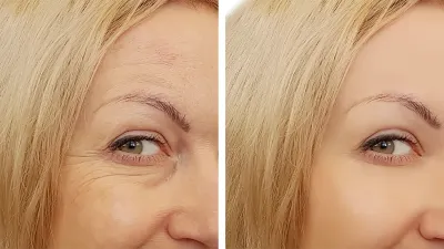 Before-After-Beauty-Wrinkle-Stock-Photo