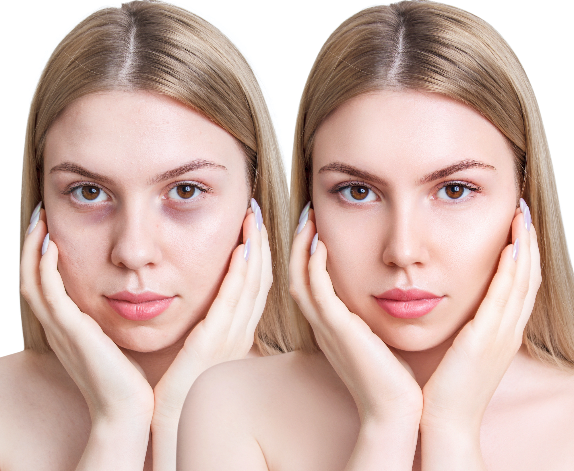 Before-After-Dark-Circles-Stock-Photo