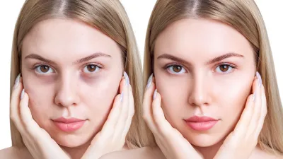 Before-After-Dark-Circles-Stock-Photo