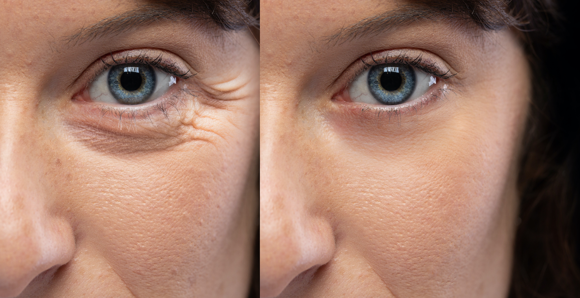 Before-After-Eye-Wrinkle-Stock-Photo