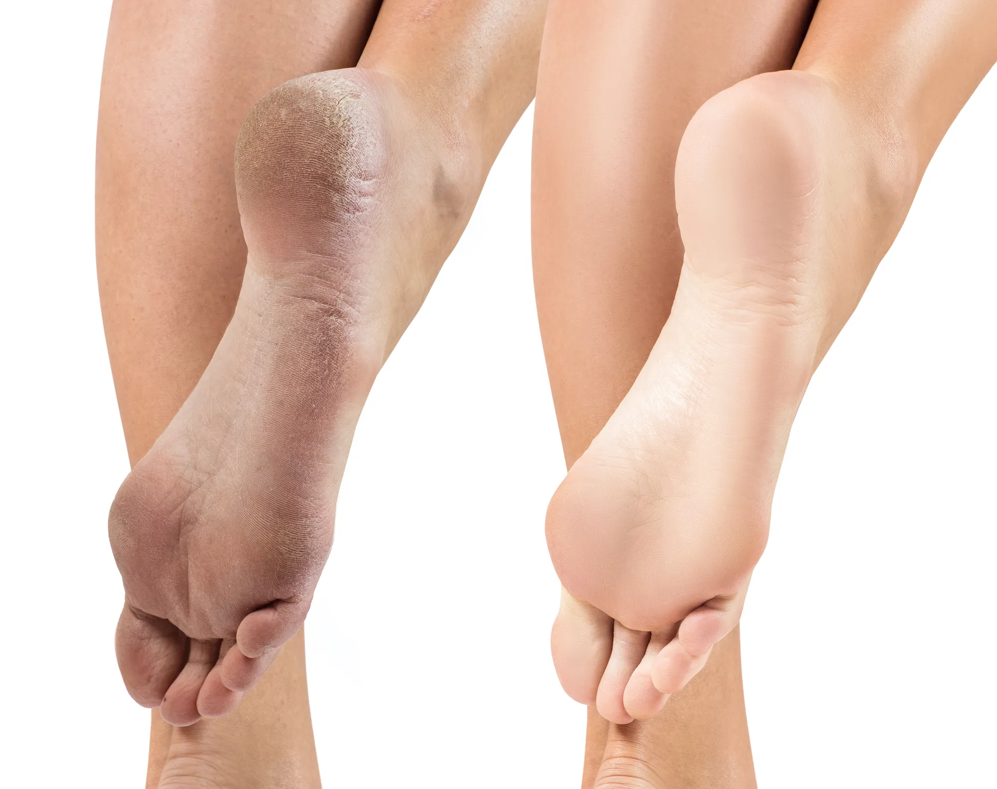 Before-After-Foot-Treatment-Stock-Photo