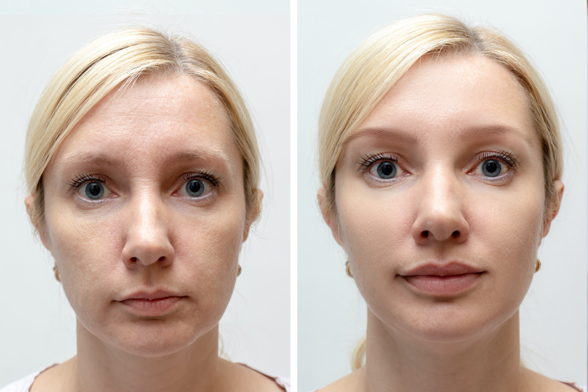 Before-After-Skin-Smoothing-Stock-Photo