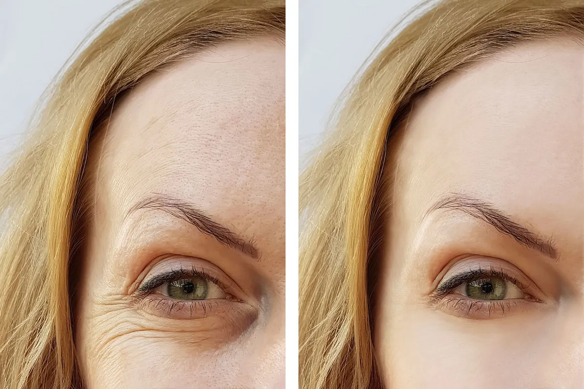 Eye-wrinkles-bothering-when-smile-Need-This-Day-and-Night-Collagen-Cream-001