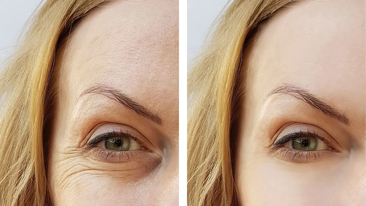 Eye-wrinkles-bothering-when-smile-Need-This-Day-and-Night-Collagen-Cream-001