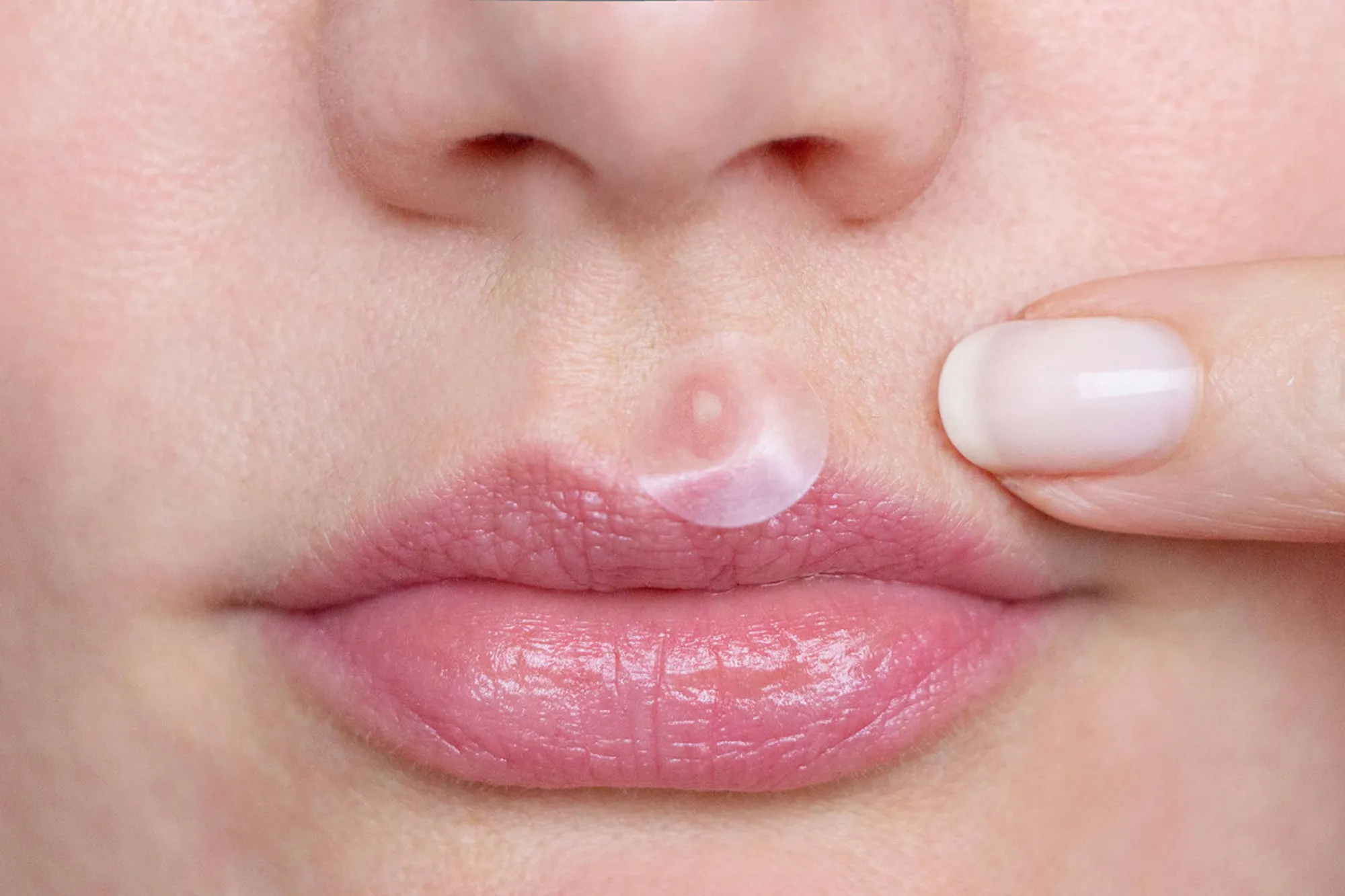 No-1-Best-Selling-Pimple-Patch-gets-rid-zits-little-6-hours-001