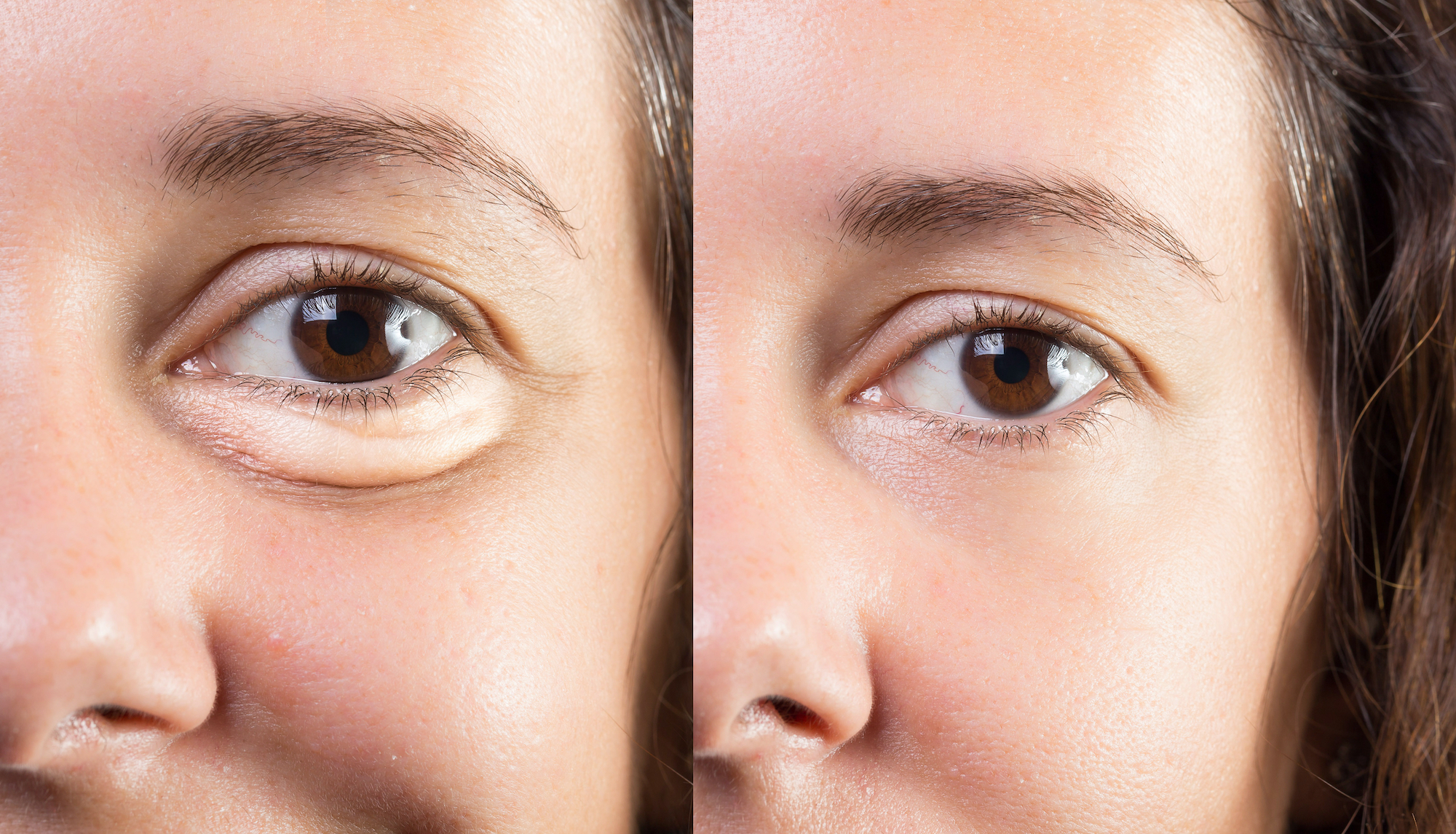 Puffy-Dark-Circle-Before-After