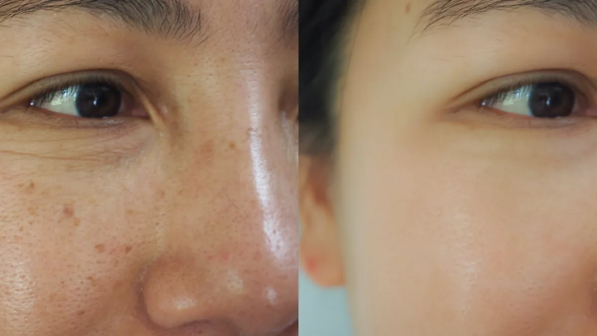 Sun-Spots-Before-After