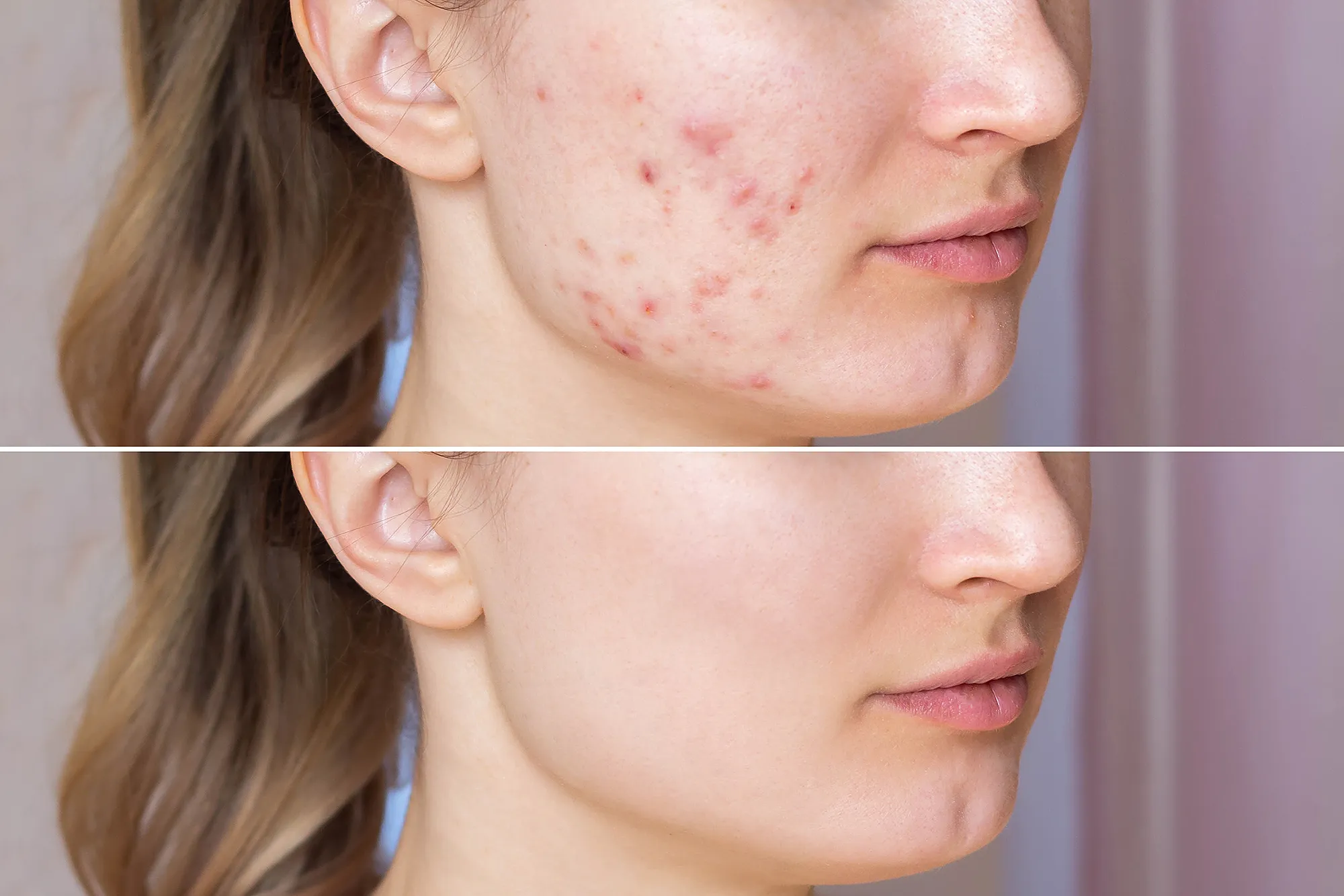acne-patches-hot-spots