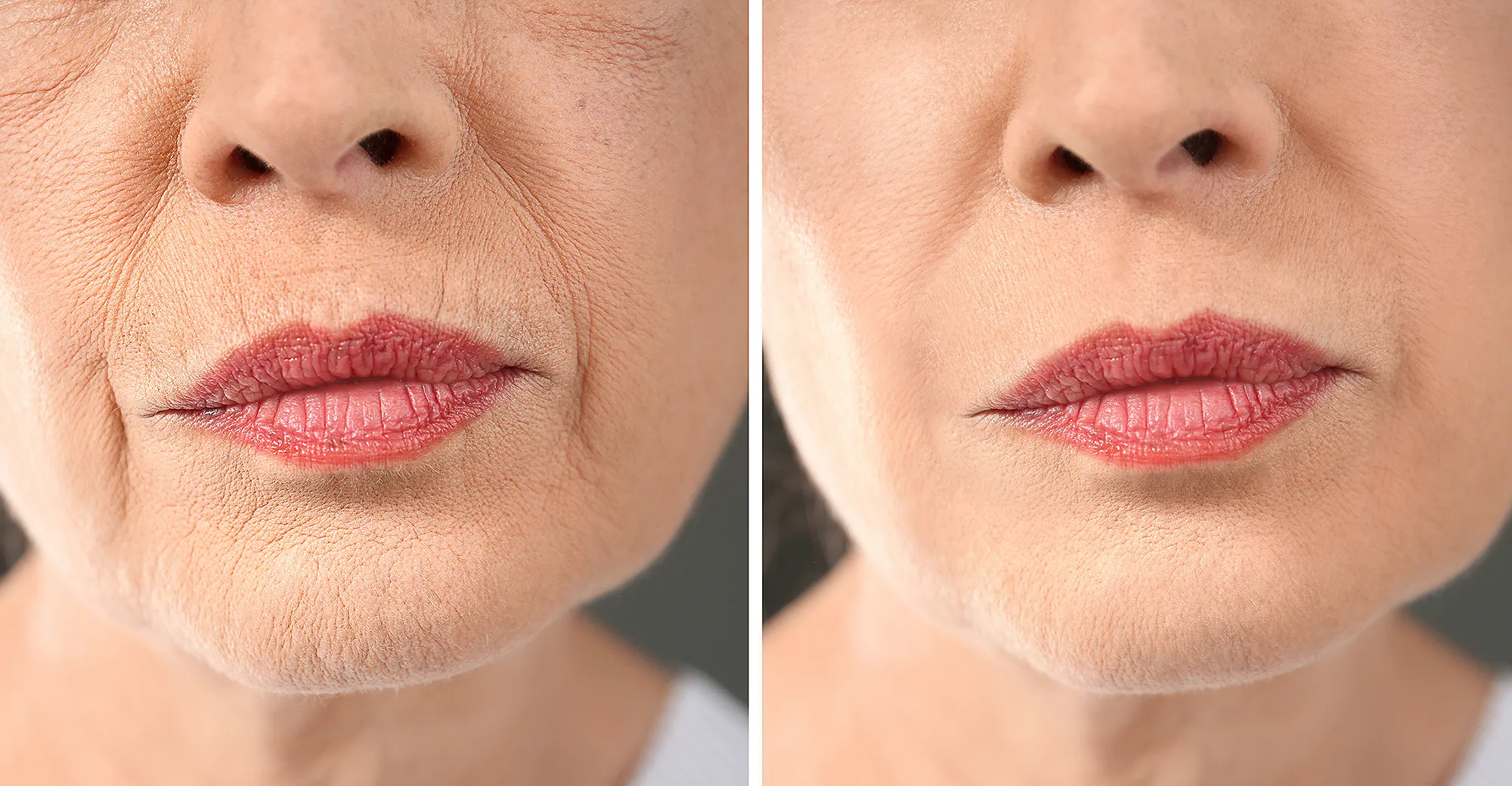 bloommy-retinol-cream-wrinkles-before-after