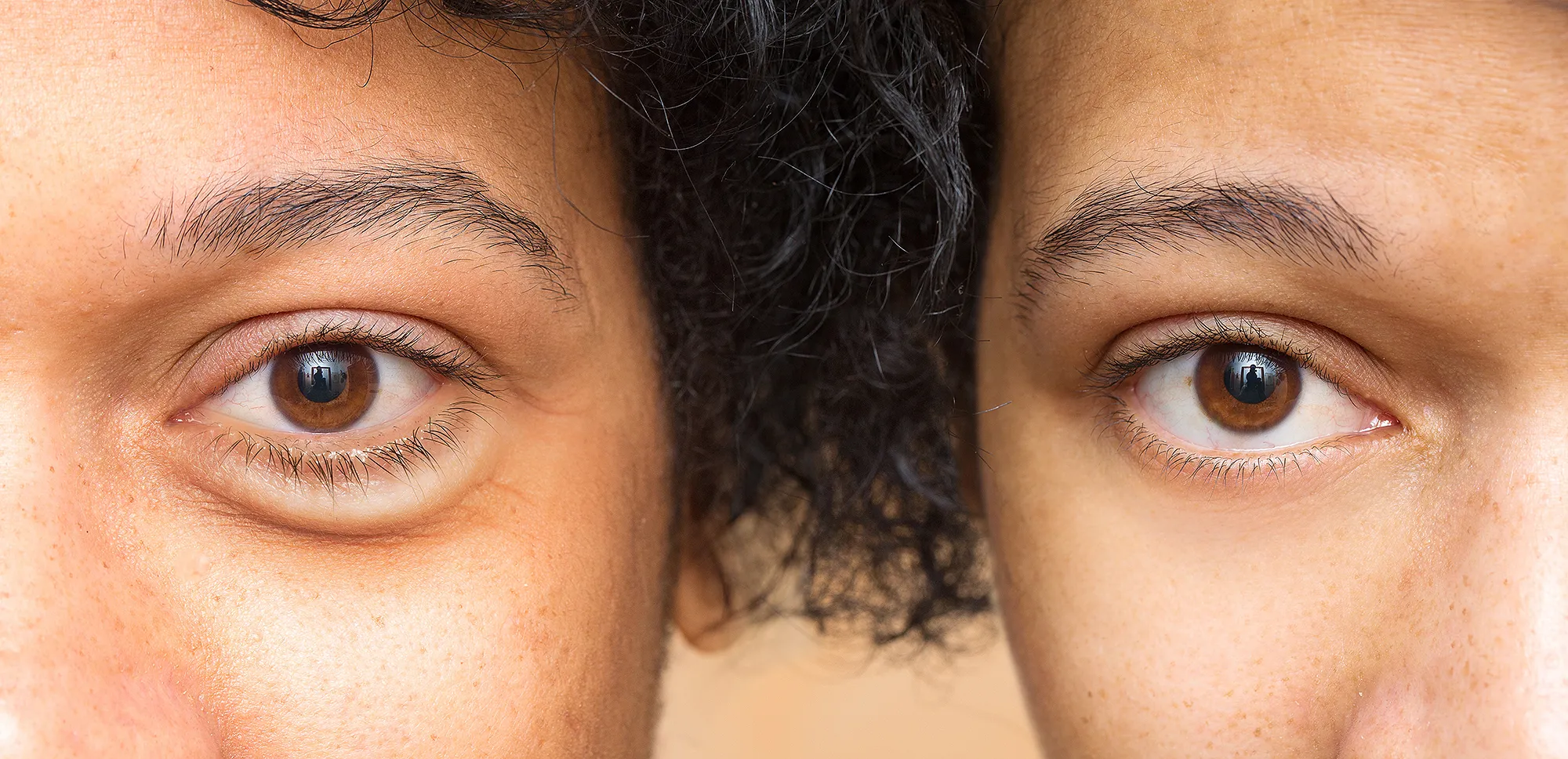 dark-circles-before-after-treatment