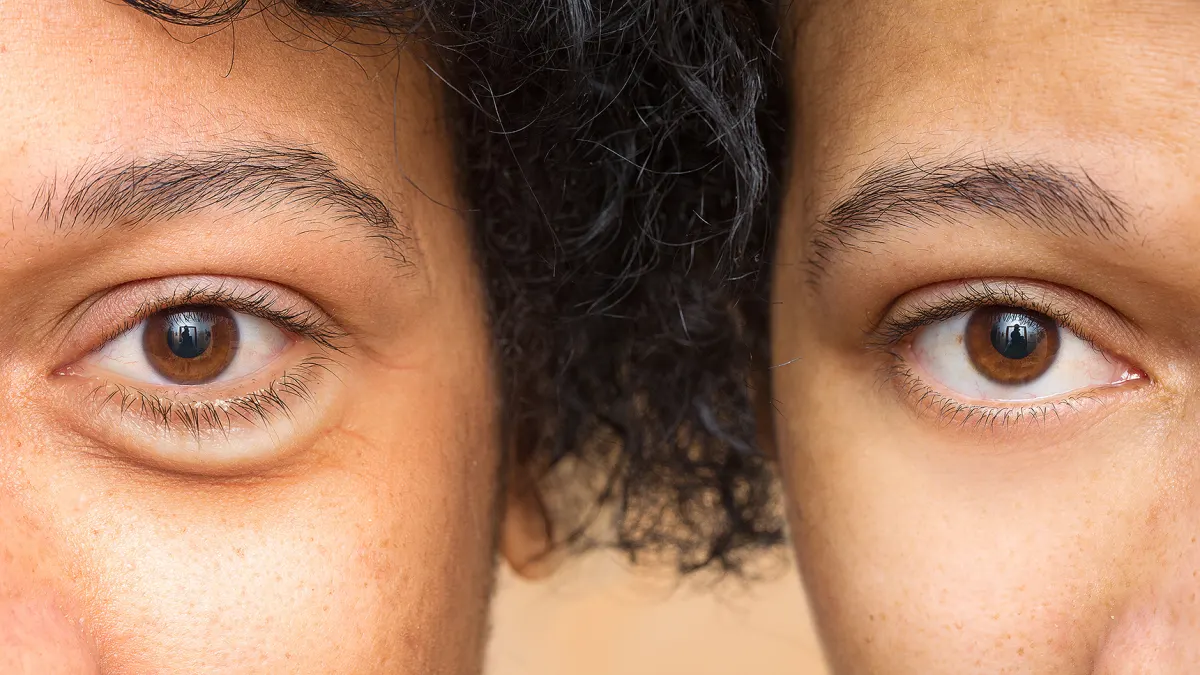dark-circles-before-after-treatment