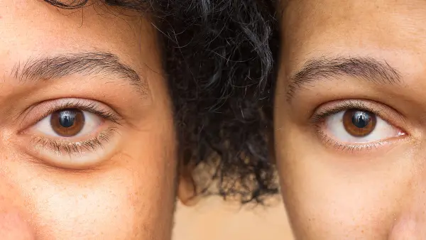 dark-circles-before-after-treatment
