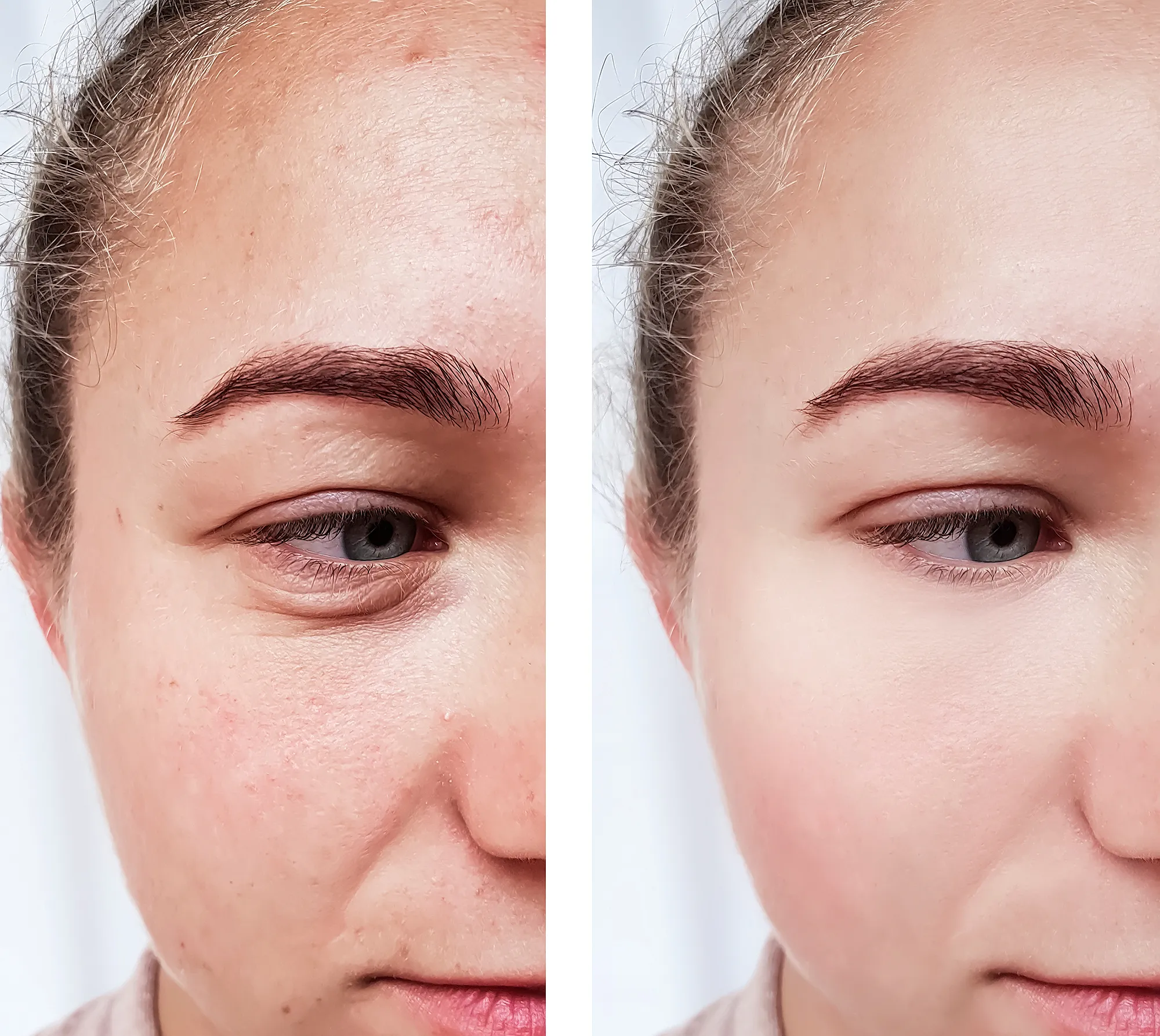 hyaluronic-acid-before-after