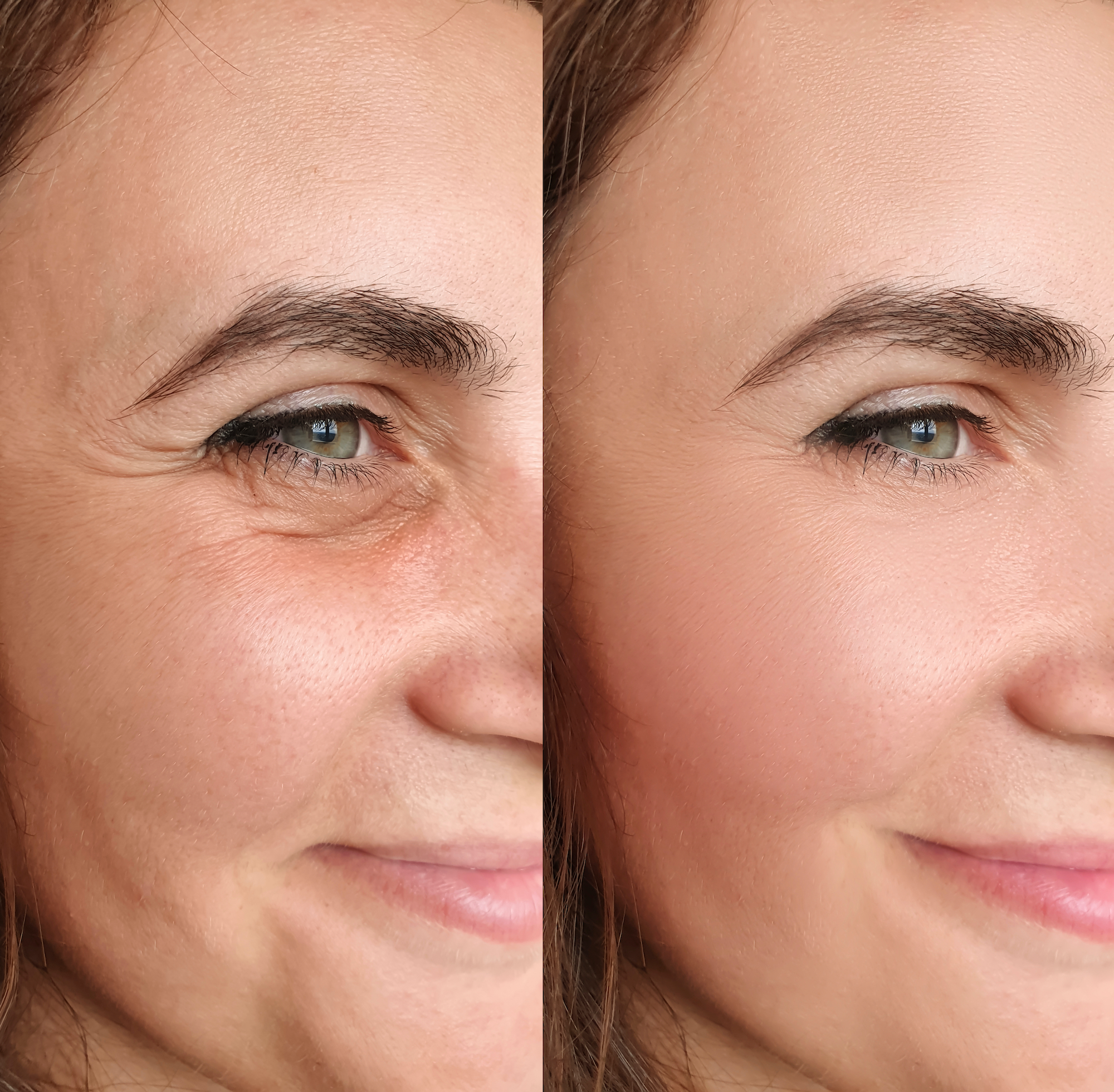 Before-After-Wrinkle-Treatment