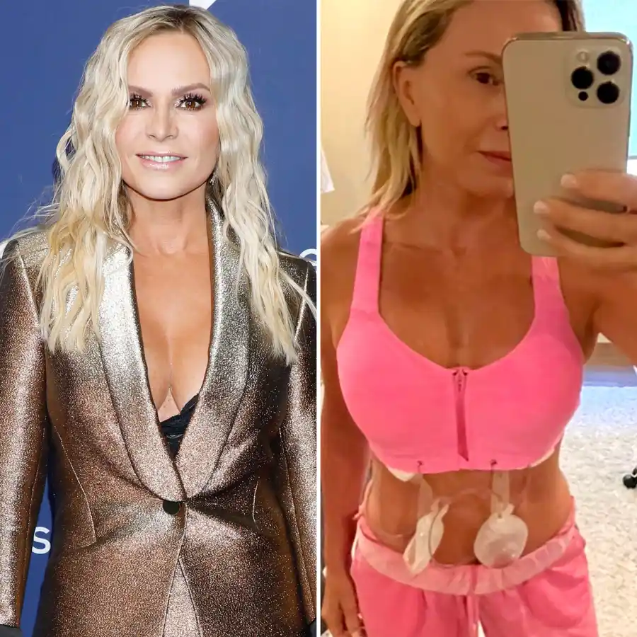 Celebs Who Admitted they got Plastic Surgery