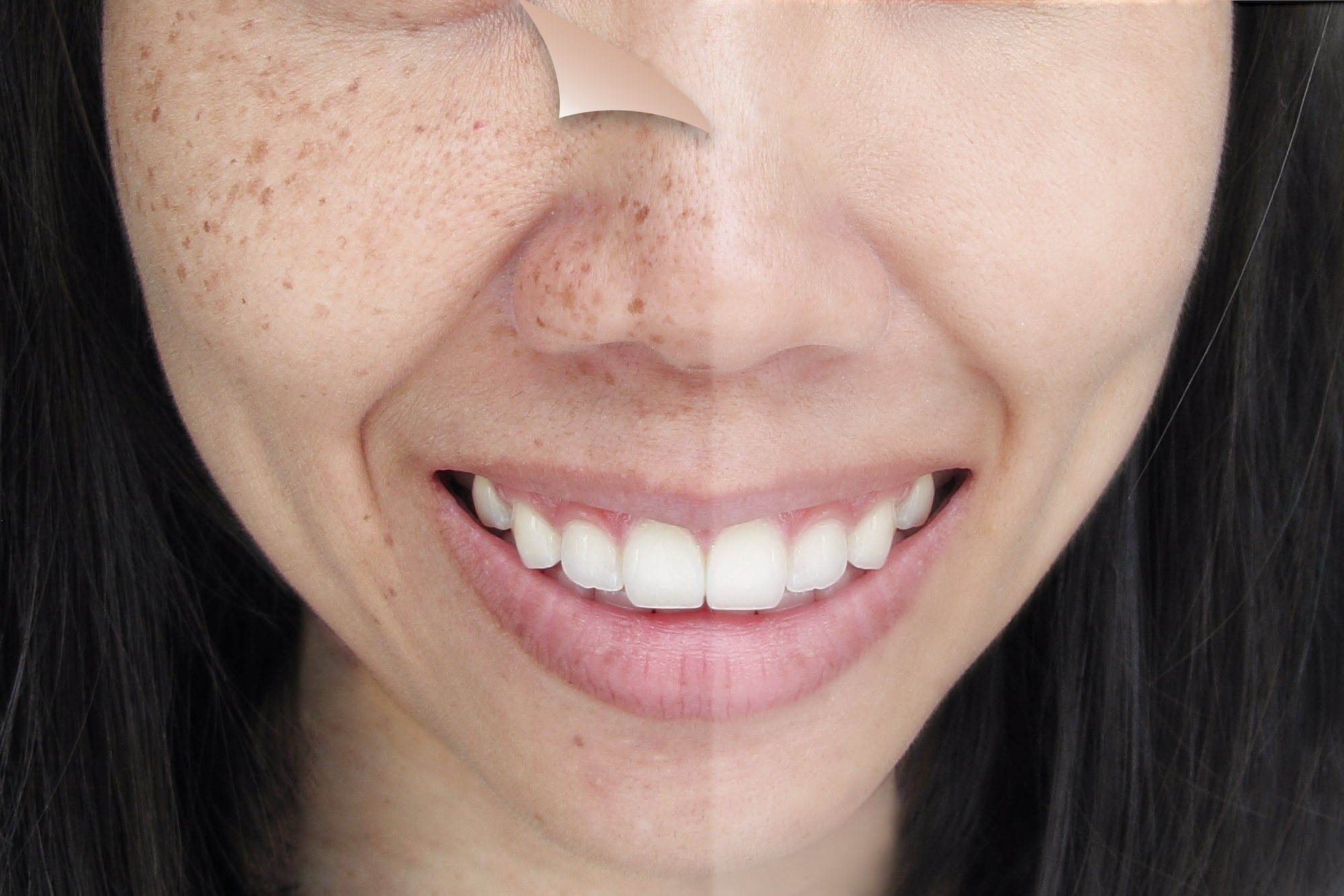 Dark-Spot-Before-After-Stock-Photo