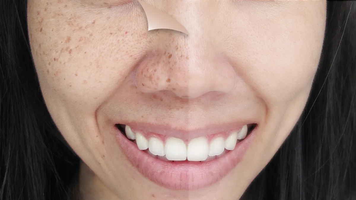 Dark-Spot-Before-After-Stock-Photo