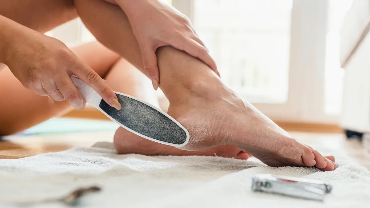 Heel-Callus-Stock-Photo