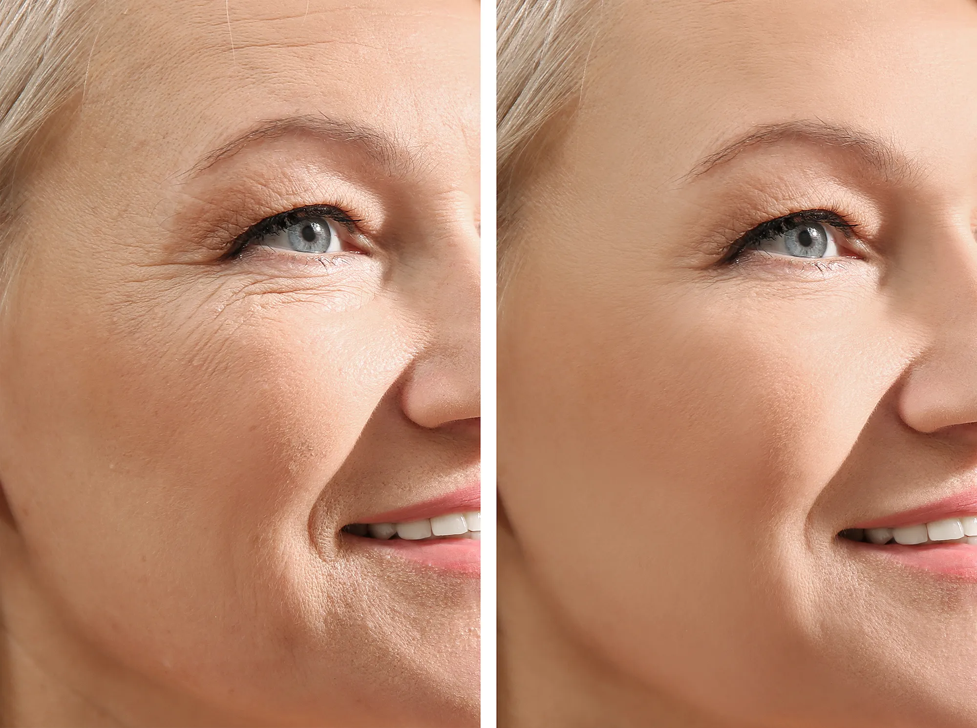 wrinkle-before-after