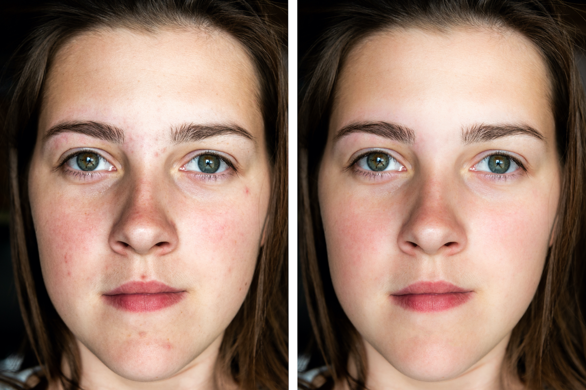 Before-After-Skincare
