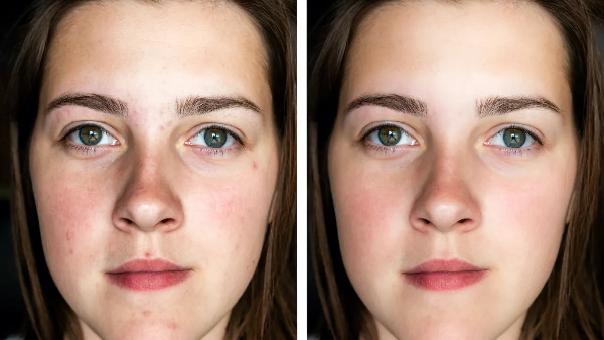Before-After-Skincare