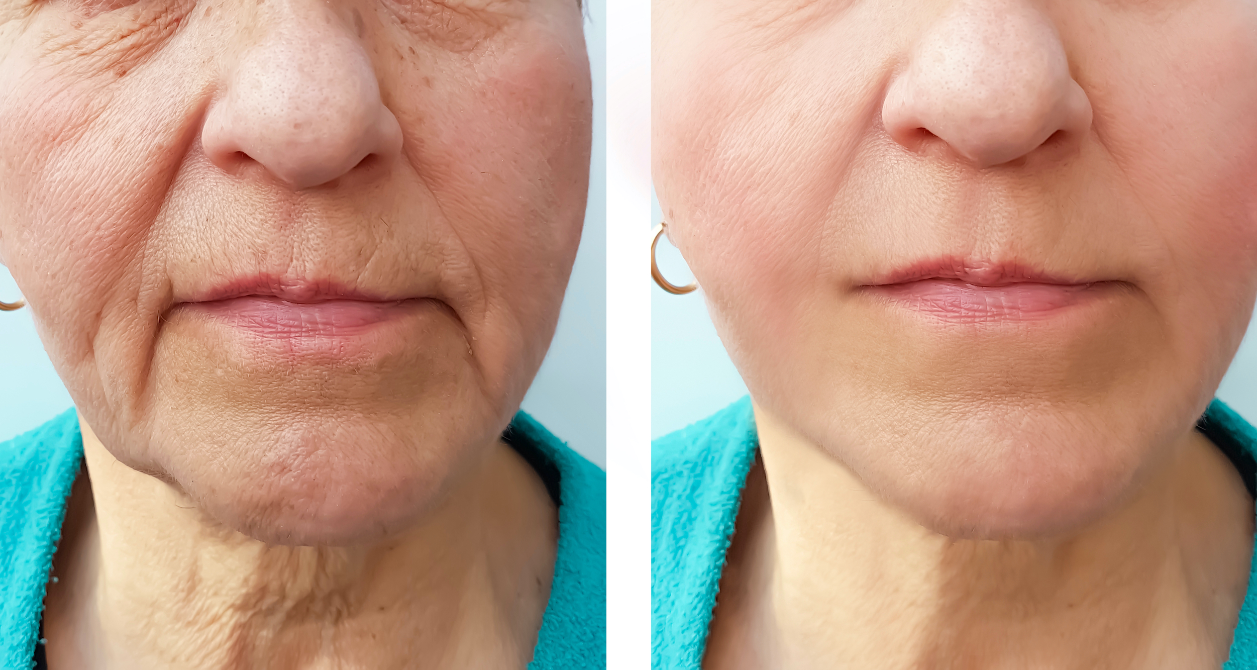 Before-After-Wrinkle-Treatment