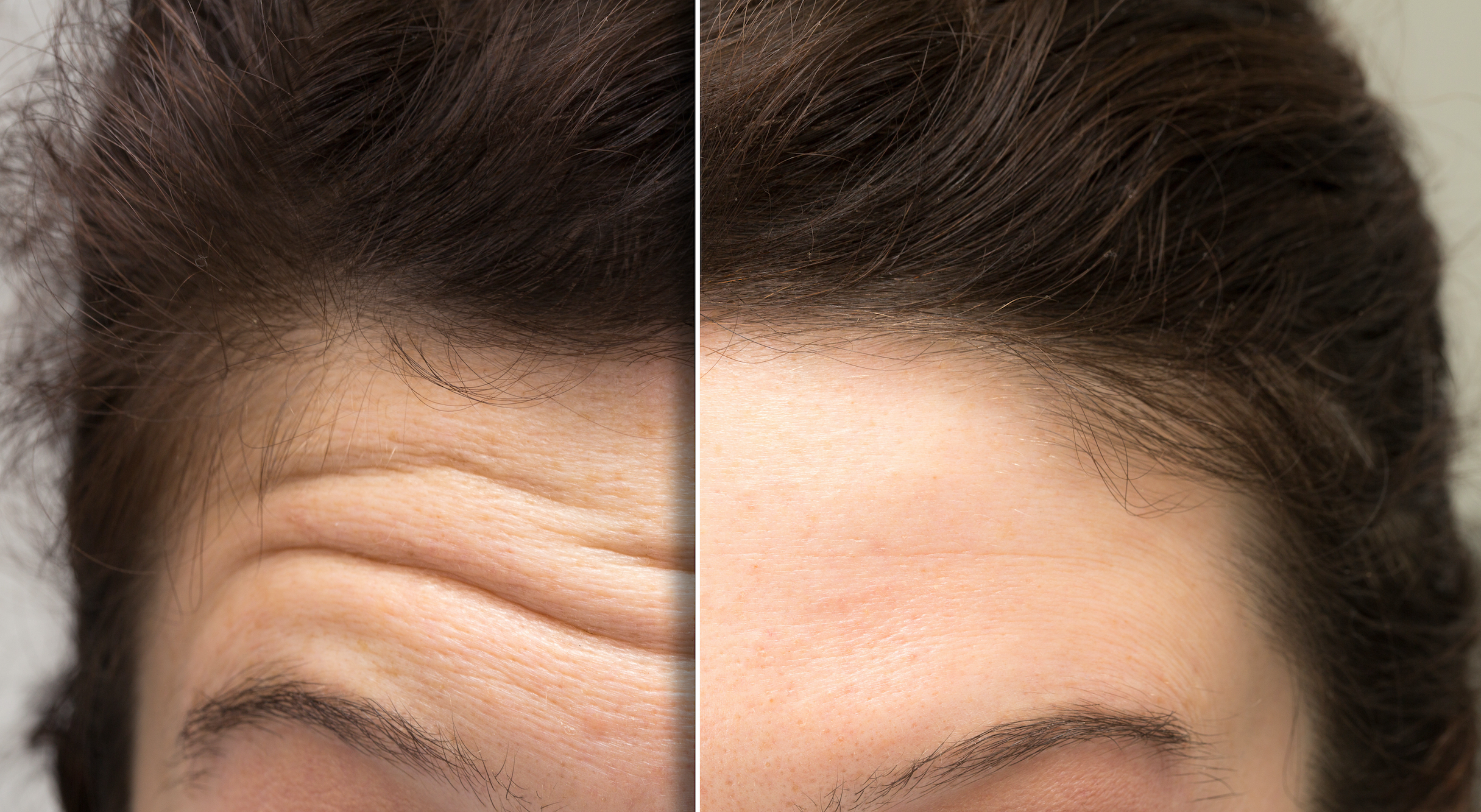 Forehead-Lines-Before-After