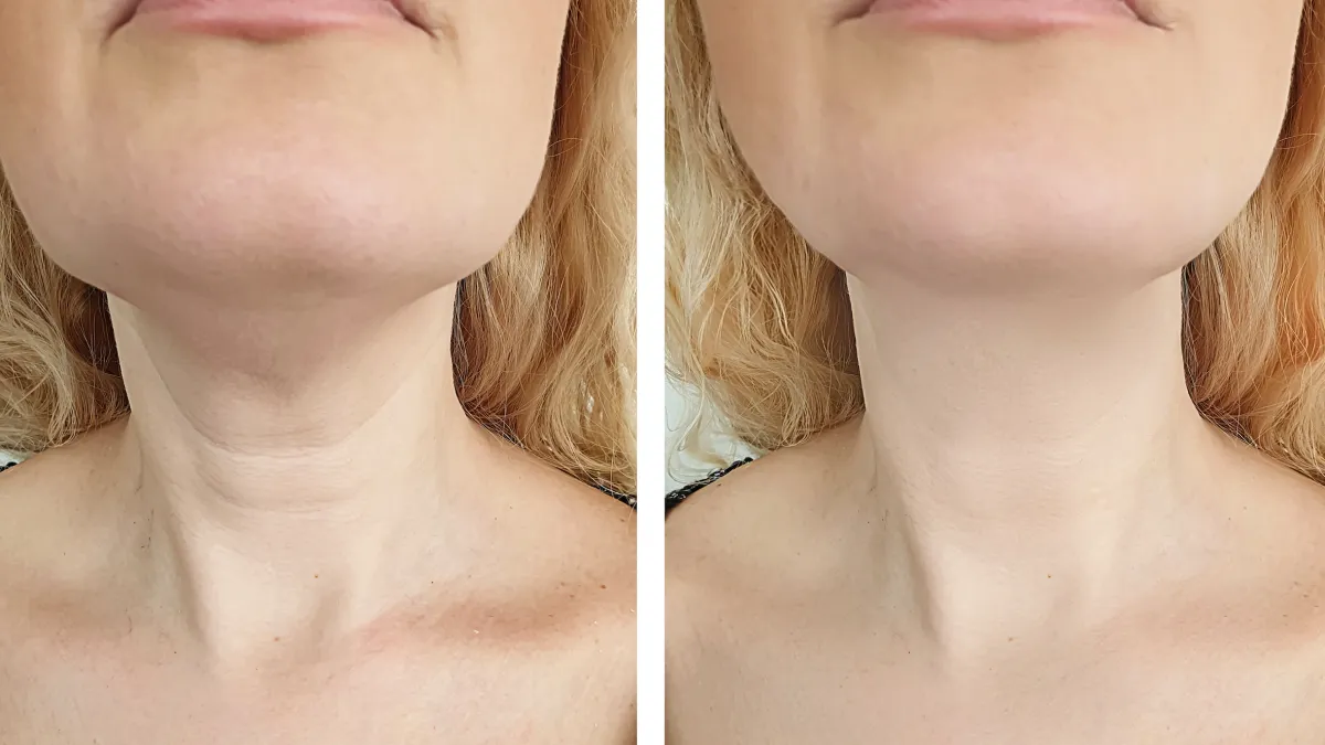 Neck-Lift-Before-After